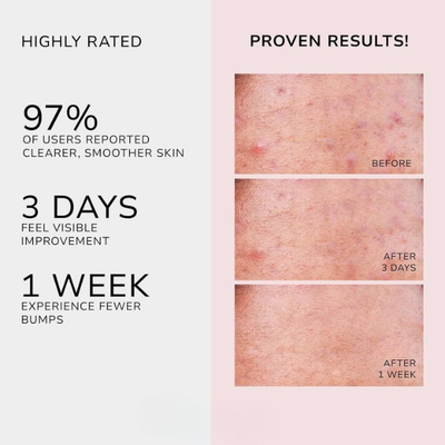 Virza Butt Acne Clearing Treatment